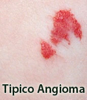 Angioma