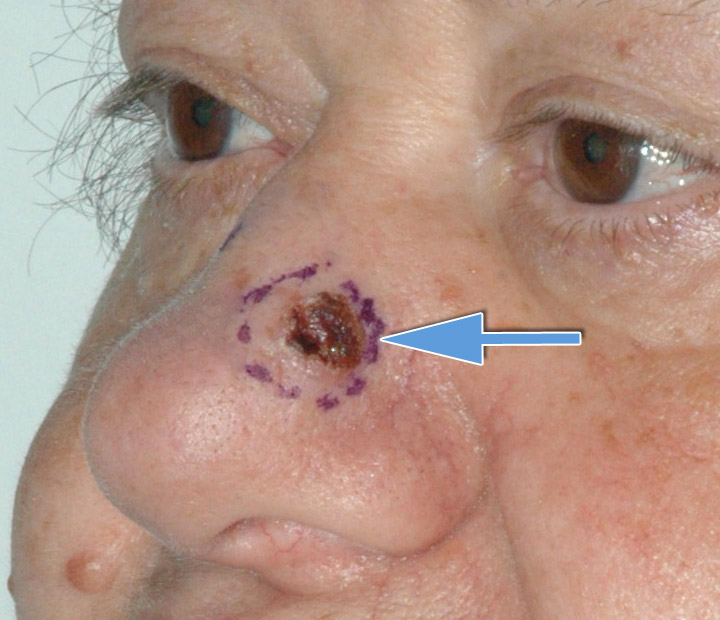 Basalioma - Carcinoma Basocellulare del Naso