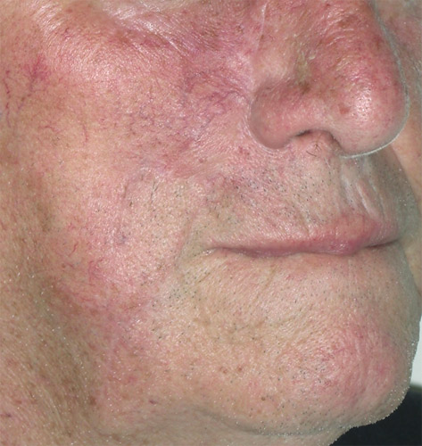 Melanoma della Guancia