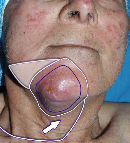 Carcinoma Spinocellulare della Cute - Spinalioma
